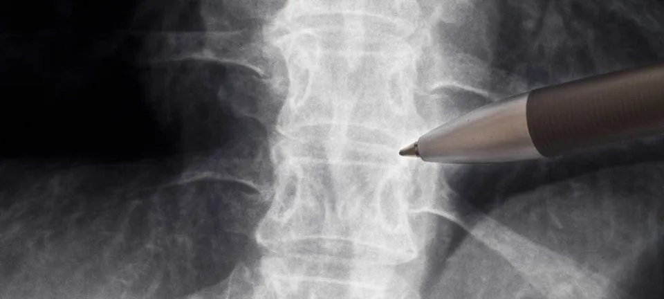 Anvisa autoriza estudo clínico com polilaminina para tratar lesão medular aguda - Imagem do artigo original