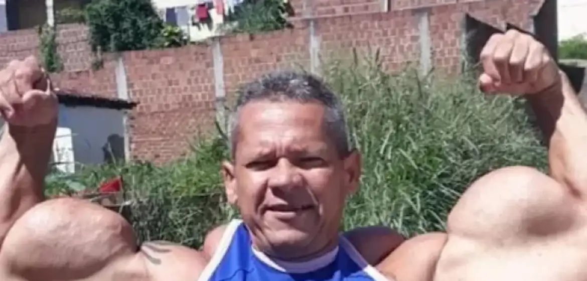 Morte de “Popeye Brasileiro” expõe riscos do uso de óleo mineral e anabolizantes - Imagem do artigo original