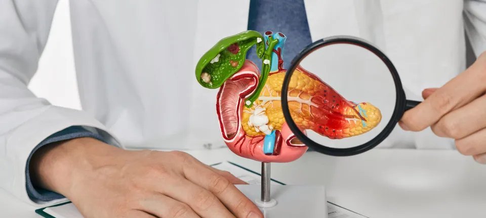 Incidência de câncer de pâncreas cresce entre adultos jovens e acende alerta médico - Imagem do artigo original