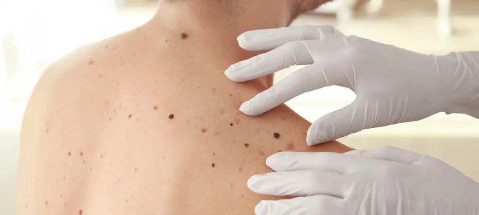 Diagnósticos de câncer de pele disparam no Brasil e expõem desigualdade no acesso - Imagem do artigo original