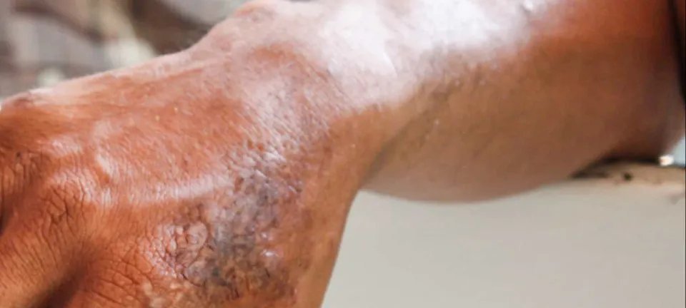 Brasil registra mais de 300 mil casos de hanseníase na última década - Imagem do artigo original